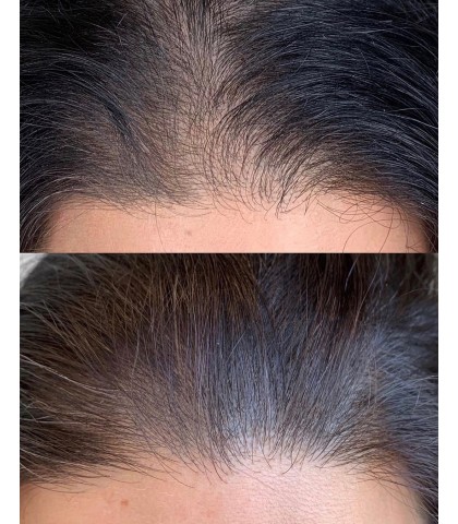 AnteAGE MD 生髮微針療程