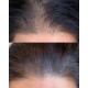 AnteAGE MD 生髮微針療程