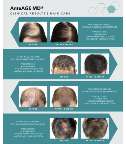 AnteAGE MD 生髮微針療程