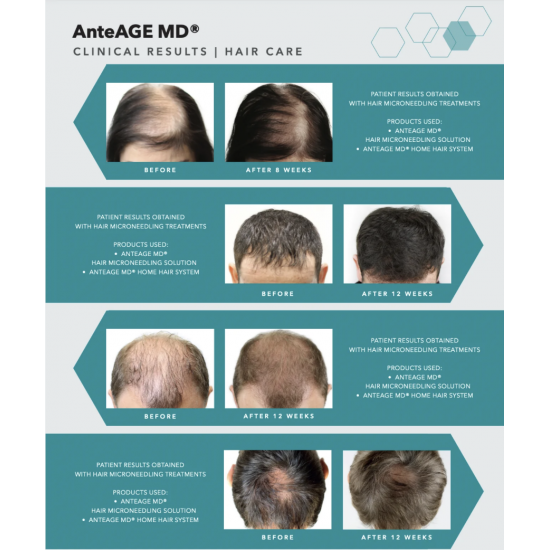 AnteAGE MD 生髮微針療程 AnteAGE MD 生髮微針療程
